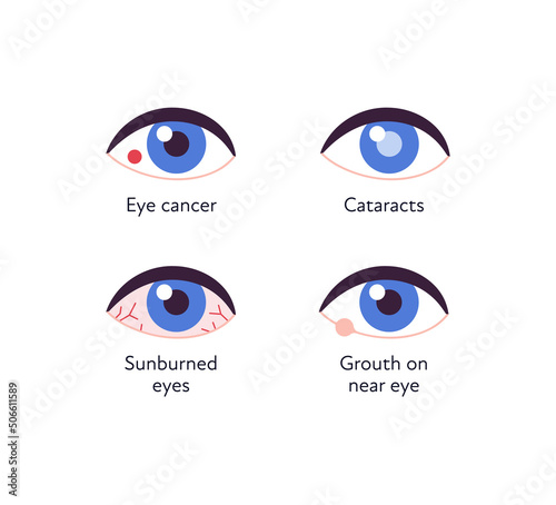 Summer uv sunscreen protection and eye diseave concept. Vector flat healthcare icon illustration set. Various eye disease symbol isolated on white. Cancer, cataract, sunburn and grouth illness.
