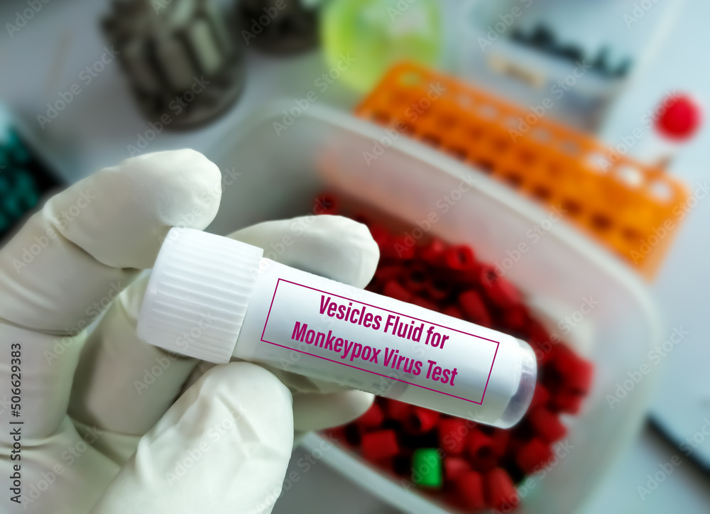 Vesicles fluid sample for Monkeypox virus test.