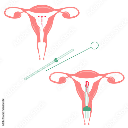 vector illustration of IUD application to prevent children
