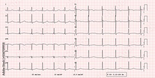 ECG example of a pathological 12-lead rhythm. Long QT syndrome, real exam photo