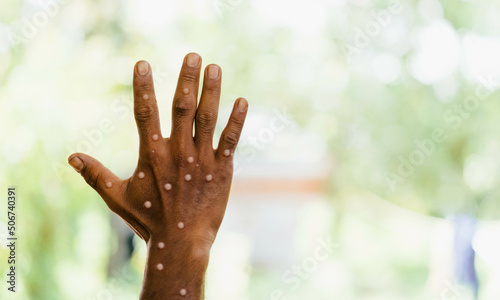 Monkeypox infection pandemic.African hand symptom monkeypox show doctor in laboratory lab confirm.Monkeypox is a rare disease infection with virus.Sexual Health.infection in Africa Europe.hand virus. photo