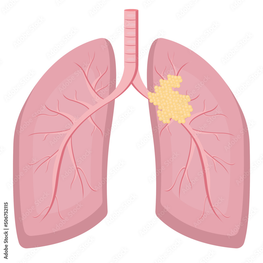 lung cancer isolated on white background lung cancer isolated on white background