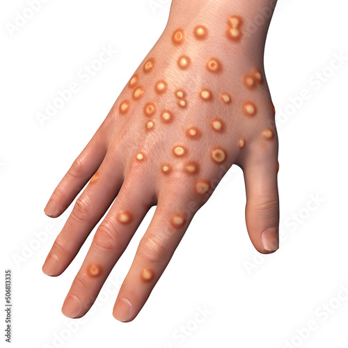 Hand of a patient with monkeypox infection, 3D illustration photo