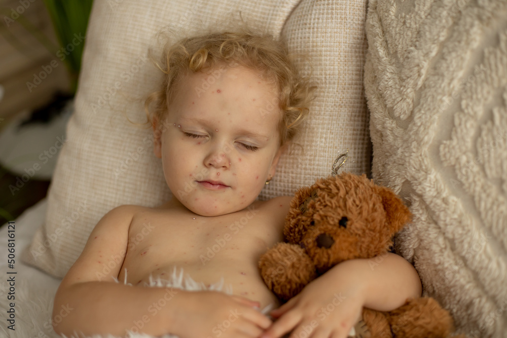 Little toddler girl with chicken pox in bed, playing at home, quarantine isolation Little toddler girl with chicken pox in bed, playing at home, quarantine isolation