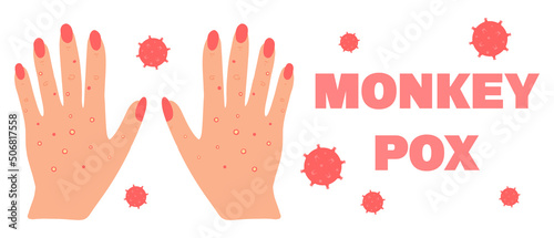 Banner with smallpox monkey. Monkeypox. Hands with a rash. Smallpox symptom. Vector illustration.