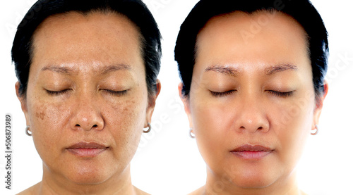 etouched image to show before and after treatment spot melasma pigmentation facial treatment on young asian woman face. Skincare and health problem concept. photo