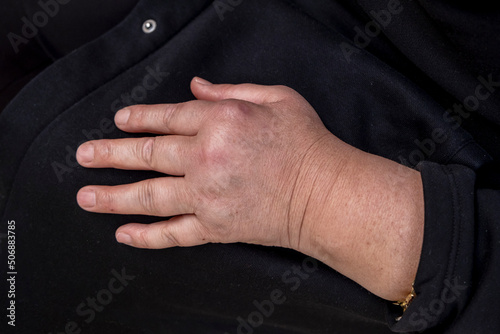Hand Of Woman Deformed From Rheumatoid Arthritis. a chronic progressive disease causing inflammation in the joints and resulting in painful deformity and immobility. © Yasin