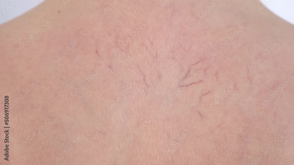 Human skin with vascular stars and couperose, bright red vessels. Vascular problems on human skin. Human skin with vascular stars and couperose, bright red vessels. Vascular problems on human skin.