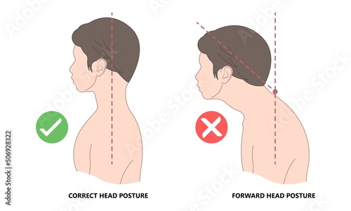 Chin Tuck Head Text neck lift pain nerve deep flexor spine inflamed bad correct poor good phone smart tablet laptop use work from home chiropractor strain upper back Jaw Joint outlet stress injury