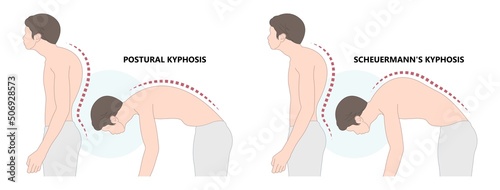 spine forward head posture chest xray neck pain lumbar Scheuermann's body discs brace sway back adam's spinal birth defect fracture cobb angle bone curved vertebrae cancer bend test exam kyphoplasty