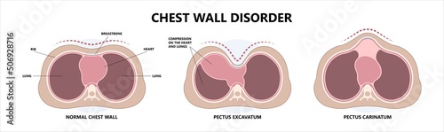 Chest wall disorder and Pectus ribs sunken funnel heart murmur lung COPD pain gene birth the barrel Marfan Ehlers Danlos Noonan Turner head thorax muscle brace sport injury Pleural effusion asthma photo