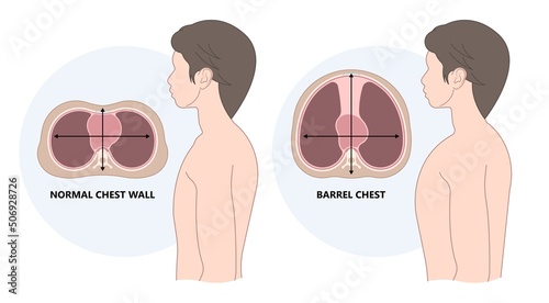 Chest wall disorder and Pectus ribs sunken funnel heart murmur lung COPD pain gene birth the barrel Marfan Ehlers Danlos Noonan Turner head thorax muscle brace sport injury Pleural effusion asthma photo