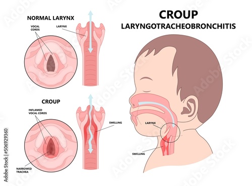 Croup upper airway obstruct virus voice box vocal cord tube swollen noise baby child cold flu sick stuffy runny nose fever common kids lung covid 19 RSV tract high pitched photo