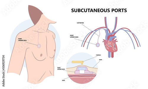 PICC Line insert neck tube vein arm blood draws heart IV needle cancer therapy Total peripheral internal double lumen chest port fluid injection large artery superior vena cava care drug implantation