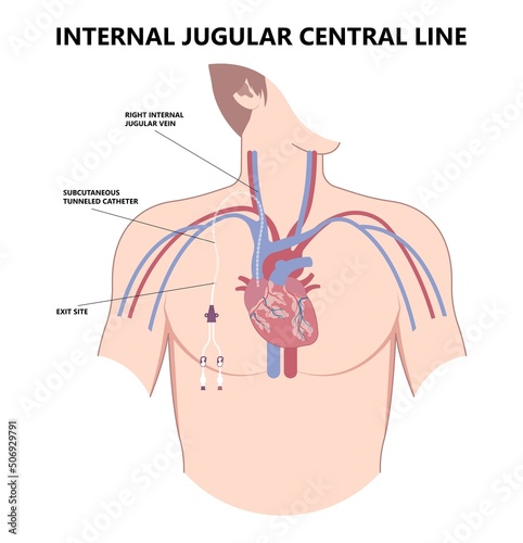 PICC Line insert neck tube vein arm blood draws heart IV needle cancer therapy Total peripheral internal double lumen chest port fluid injection large artery superior vena cava care drug implantation