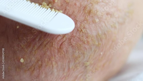 removing seborrheic dandruff flakes crusts off newborn baby child head with white comb. close-up view of infant's kid seborrhea dermatitis in hair. medical skin problem, combing and exfoliation photo