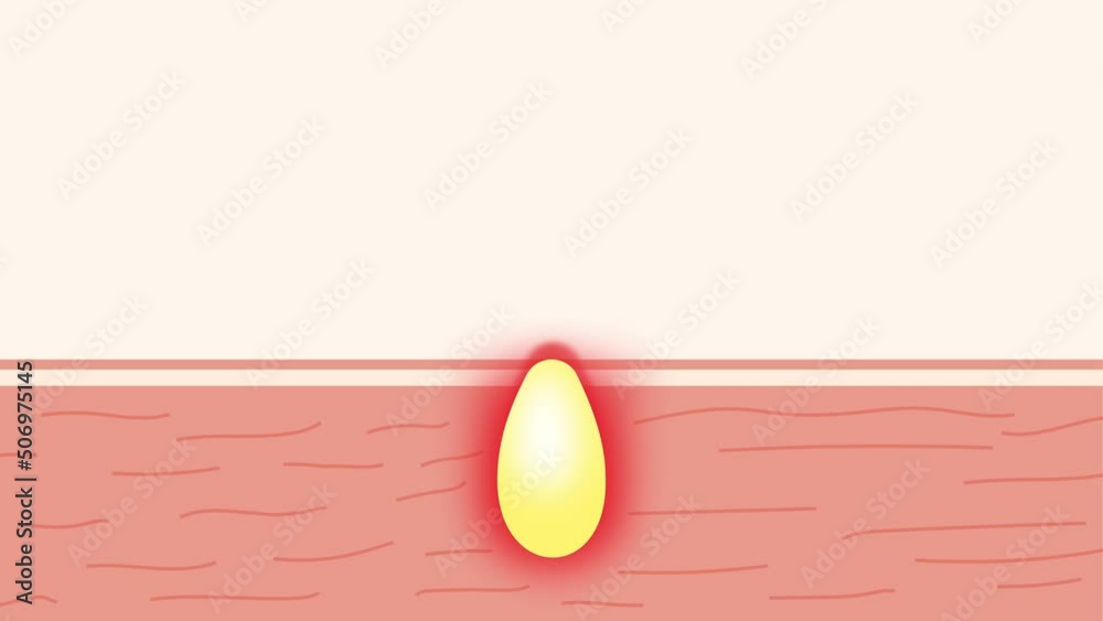 Pimple or acne growing inside the skin 4K animation. Pus increasing inside a pimple and giving red pain signal 4K footage. Acne with yellow pus on the human skin hurting with red signal video.