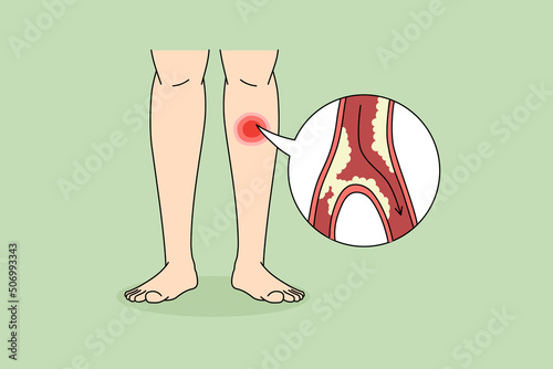 Close up of person suffer from PAD disease having blood vessel blockage in legs. Man struggle with clotted limbs from veins narrowing or blocking. Healthcare concept. Vector illustration. 