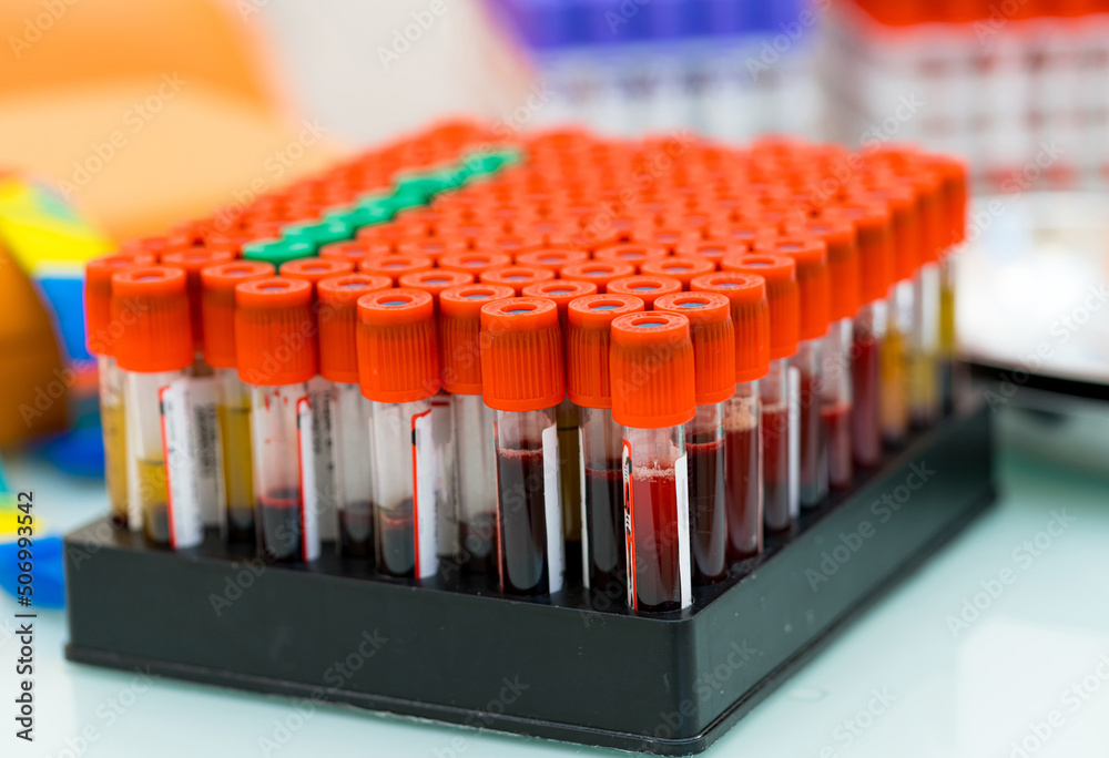 Hospital blood analyzing samples. Blood test tubes close up in laboratory. Hospital blood analyzing samples. Blood test tubes close up in laboratory.