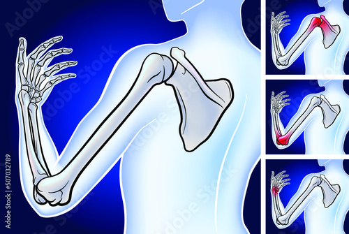 3D illustration of bone from scapula to fingertip showing the location of three pain points on a dark blue background. It is used in medicine, education and science.
