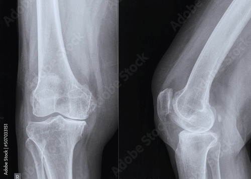 Osteoarthritis knee. show narrow joint space, osteophyte ( spur ), subchondral sclerosis due to degenerative change photo