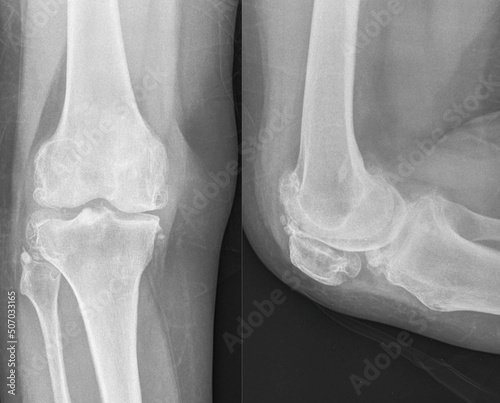 Osteoarthritis knee. show narrow joint space, osteophyte ( spur ), subchondral sclerosis due to degenerative change photo