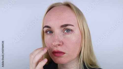 Allergy to cosmetics. The girl looks at the pimples around her eyes that appeared after using toxic cosmetics. Red spots on woman skin