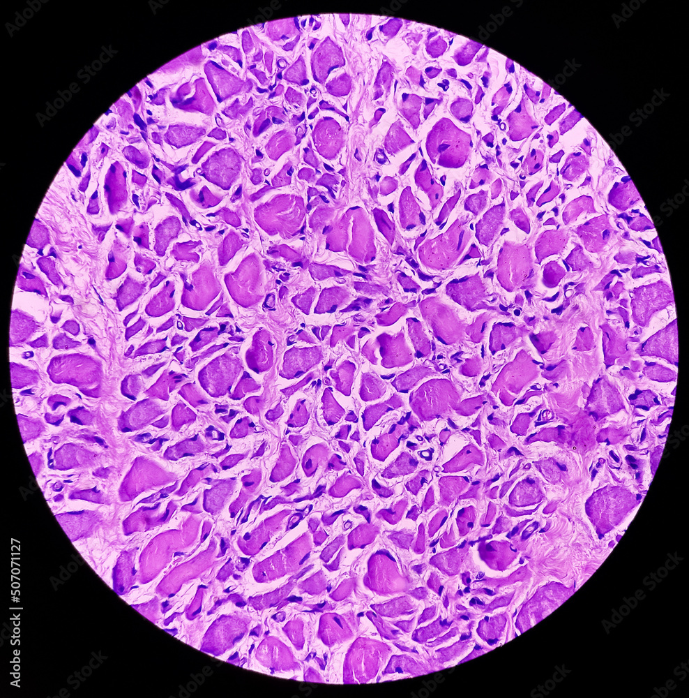 Rhabdomyoma of adductor longus, show features of rhabdomyoma. Rare benign tumors of adductor longus muscle, no malignancy. Rhabdomyoma of adductor longus, show features of rhabdomyoma. Rare benign tumors of adductor longus muscle, no malignancy.