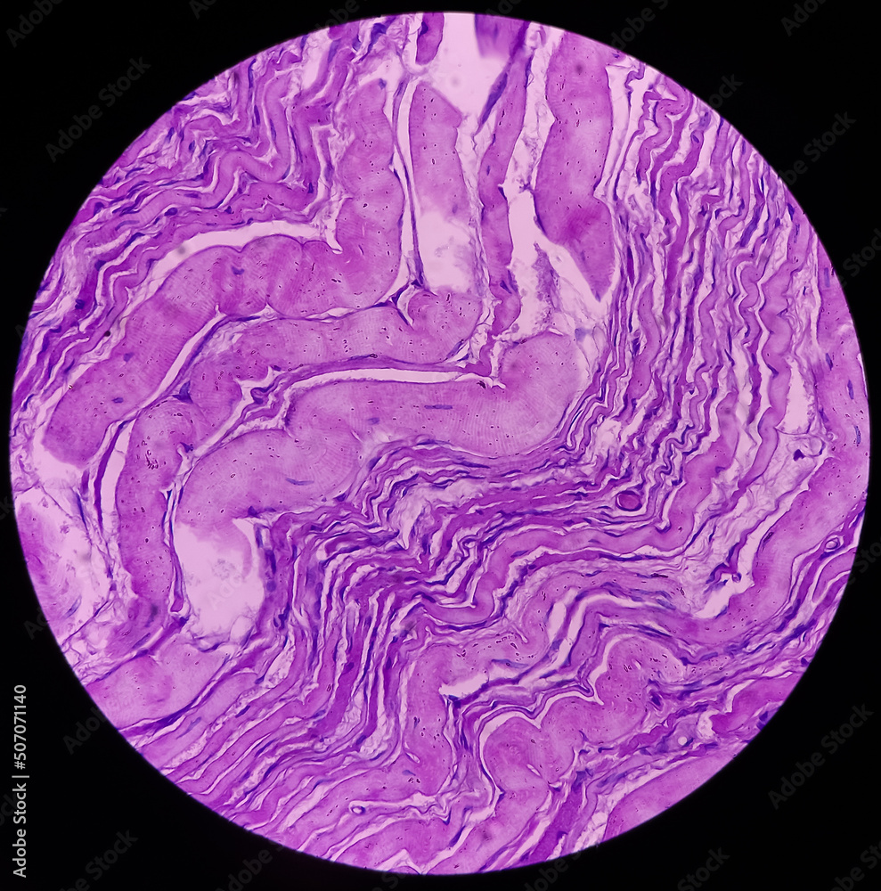 Rhabdomyoma Of Adductor Longus, Show Features Of Rhabdomyoma. Rare 