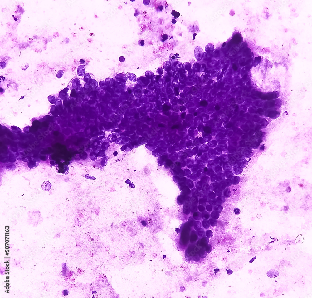 Scar endometriosis(FNA), microscopic image show benign epithelial cells and stromal cells