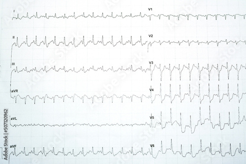 A positive stress induced myocardial ischemia with significant horizontal ST depression changes in the stress ECG ElectroCardioGram test, Patient was exercised according to Bruce protocol photo