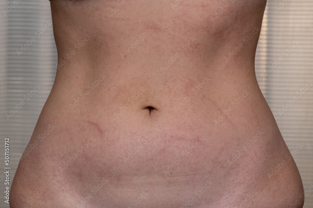 Femenine stomach with marks of allergy