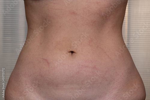 Femenine stomach with marks of allergy