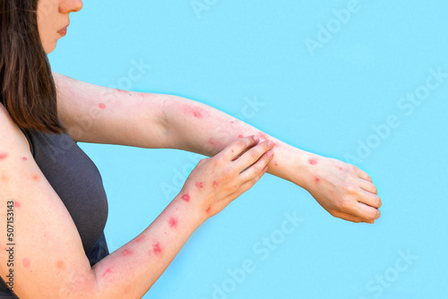 Fotografie Monkeypox new disease dangerous over the world