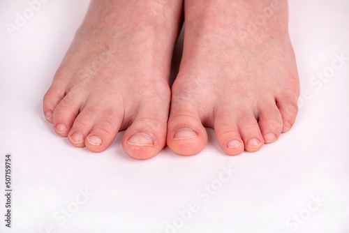 Syndactyly. Fused toes of a child, close-up on a light background