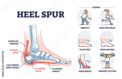 Heel spur problem or calcaneal bone condition causing pain in feet outline diagram. Labeled educational medical scheme with achilles tendon and plantar fascia inflammation anatomy vector illustration. photo