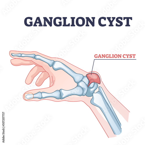 Ganglion cyst as tendon fluid filled swelling near arm joint outline diagram. Labeled educational scheme with anatomical hand bump xray explanation vector illustration. Painful wrist pathology growth. photo