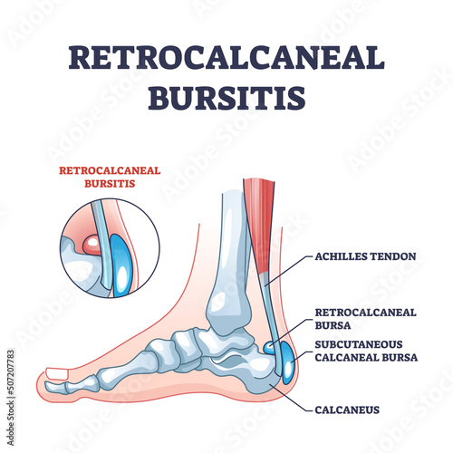 Retrocalcaneal bursitis as ankle achilles tendon bursa outline diagram. Labeled educational medical condition with ligament or achilles tendon retrocalcaneal or subcutaneous pain vector illustration. photo