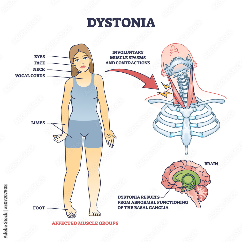 Dystonia disorder as abnormal muscle spasms and contractions outline diagram. Labeled
