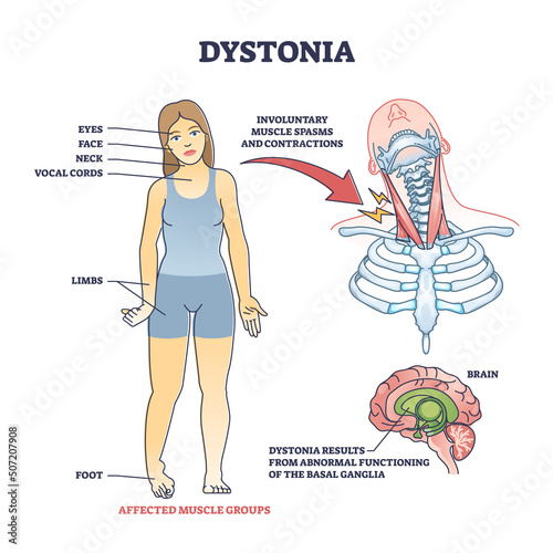 Dystonia disorder as abnormal muscle spasms and contractions outline diagram. Labeled educational scheme with affected body areas and symptoms vector illustration. Result of basal ganglia dysfunction. photo