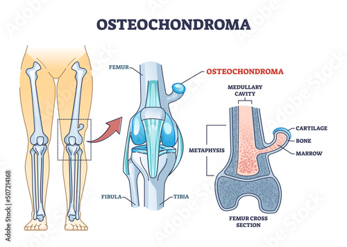 Osteochondroma knee problem as medical bone tumor overgrowth outline diagram. Labeled educational scheme with leg pathology explanation vector illustration. Femur cross section anatomical structure.