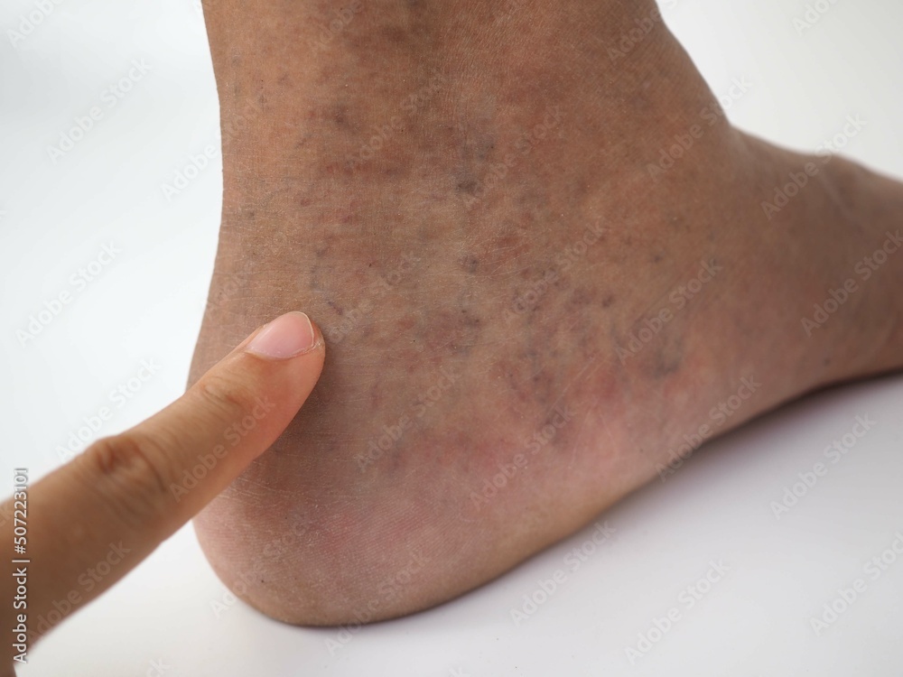 Varicose veins on a leg and foot. closeup photo, blurred. Varicose veins on a leg and foot. closeup photo, blurred.