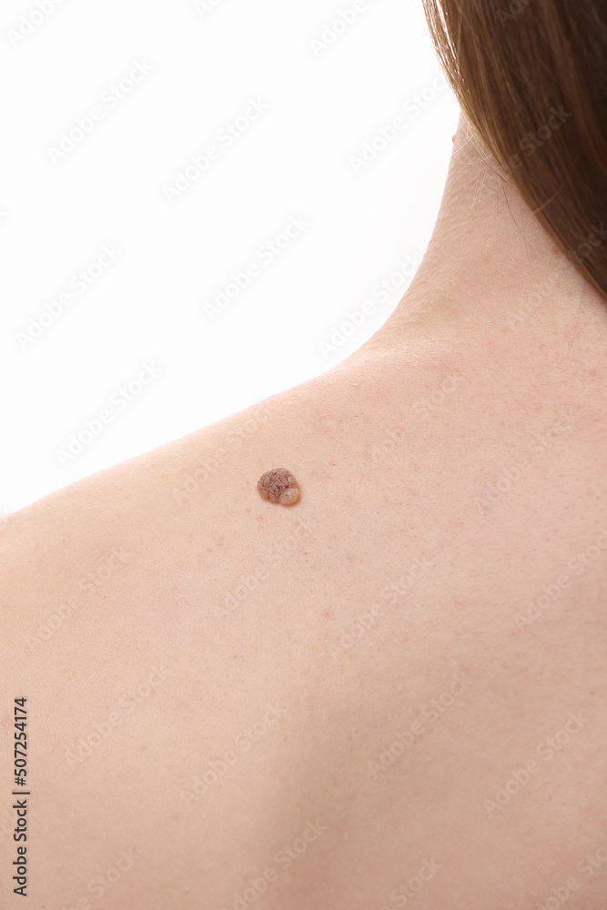 large nevus wart on young female shoulder, woman visiting doctor dermatologist, concept of benign neoplasms on human skin, regular examination and treatment. large nevus wart on young female shoulder, woman visiting doctor dermatologist, concept of benign neoplasms on human skin, regular examination and treatment.