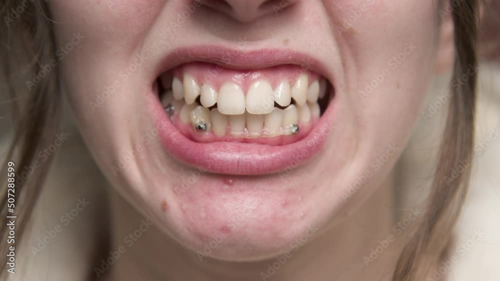 The concept of dental care and dentistry. Close-up of a happy unrecognizable caucasian woman smiling at camera, Elasticated braces set for teeth alignment and bite. The concept of dental care and dentistry. Close-up of a happy unrecognizable caucasian woman smiling at camera, Elasticated braces set for teeth alignment and bite.