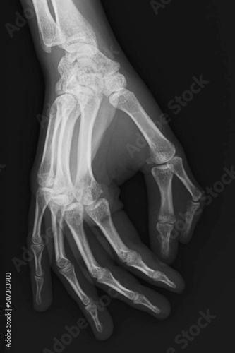 Hand polydactyly x ray  Polydactyly   hyperdactyly  refers to the situation where there are more than the usual number of digits  five  in a hand or foot