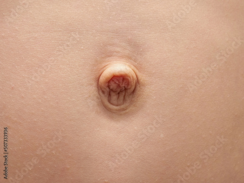 Small umbilical hernia, belly button of a 9 year old boy