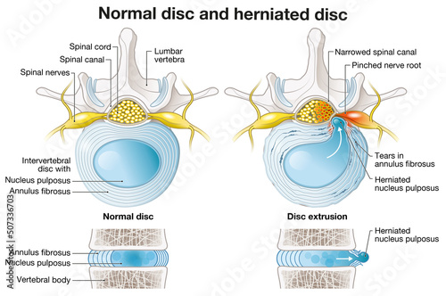 Normal disc and herniated disc, slipped disc, labelde illustration photo