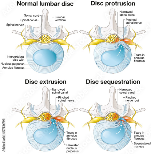 Normal lumbar disc. Disc protrusion. Disc extrusion. Disc sequestion. Labeled illustration