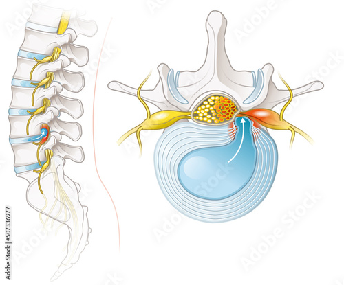 Herniated disc of the lumbar spine, stenosis, slipped disc. Medical illustration photo