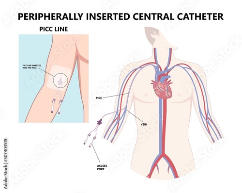 PICC Line insert neck tube vein arm blood draws heart IV needle cancer therapy Total peripheral internal double lumen chest port fluid injection large artery superior vena cava care drug implantation photo
